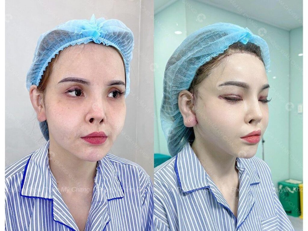 Trán hài hòa nhờ hạ đường chân tóc tại CHANGI