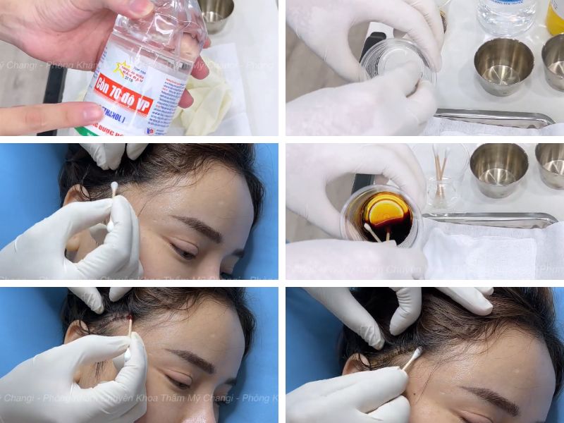 Các bước vệ sinh vết thương căng da mini plus