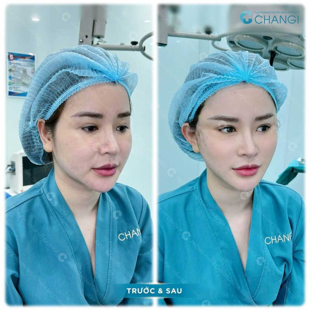 Căng cơ nội soi phù hợp với tình trạng lão hóa vừa phải