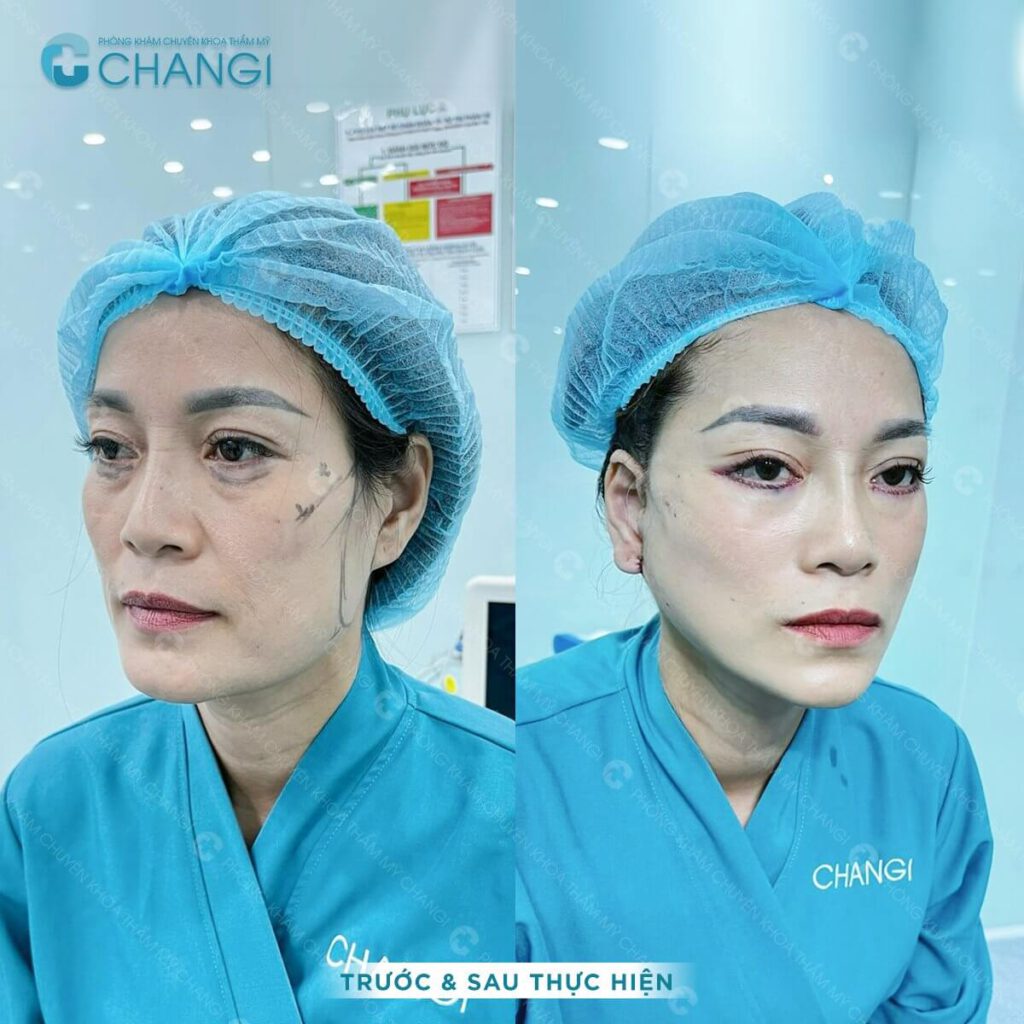 Căng da mini plus giúp khách hàng trẻ trung hơn