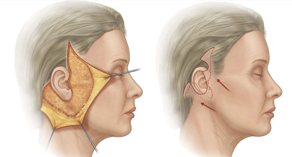 Cơ chế hoạt động của căng da mini plus