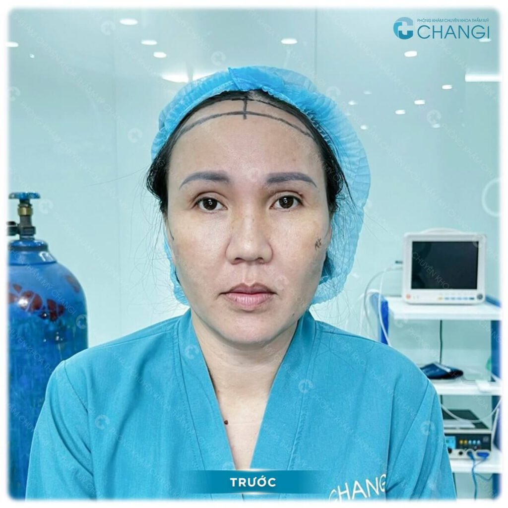 Những dấu hiệu cần căng da mini plus