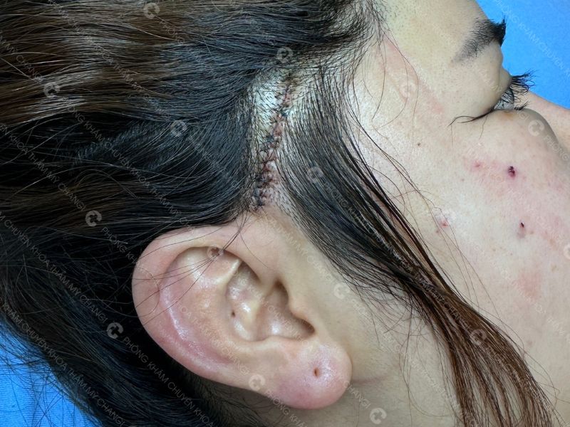 Đường may của căng cơ nội soi