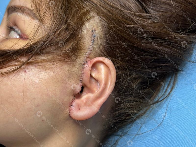 Đường may của căng da mini plus