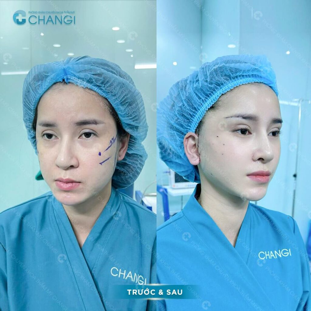 Kết quả sau khi căng da mini plus tại CHANGI