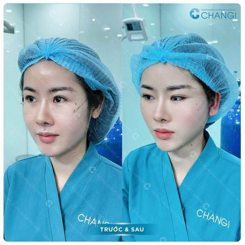 Hiệu quả sau khi thực hiện căng da mini plus