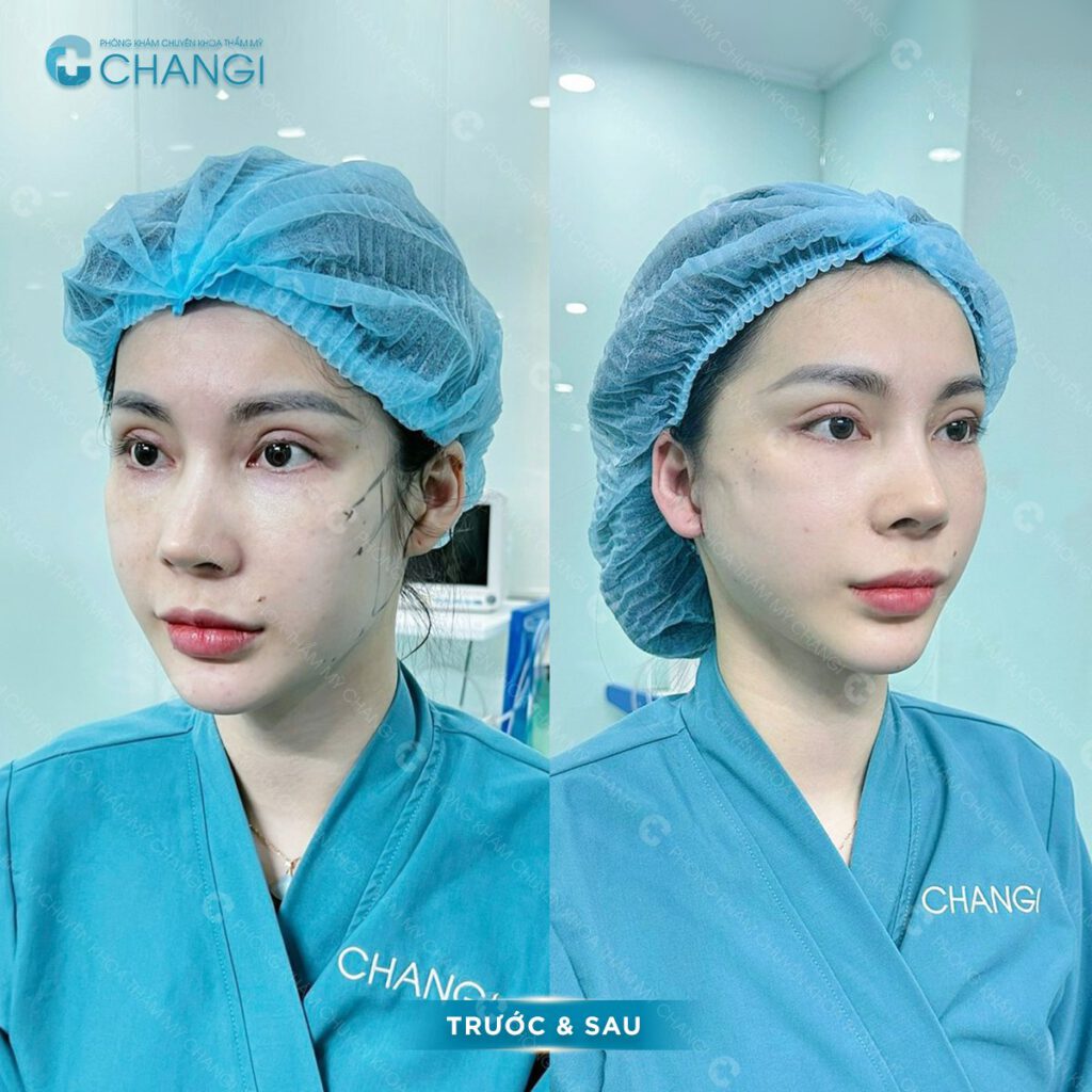 Hiệu quả, ưu điểm sau khi căng da mini plus