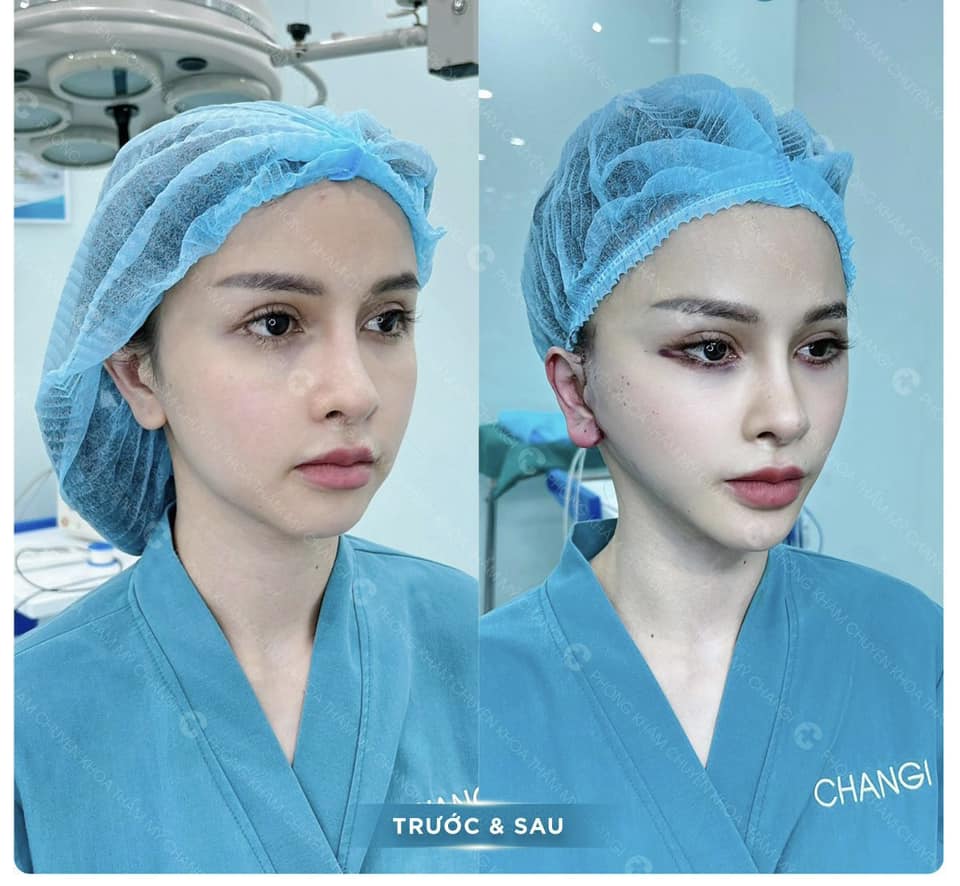 Khách hàng đã căng thẳng da Mini Plus thành công