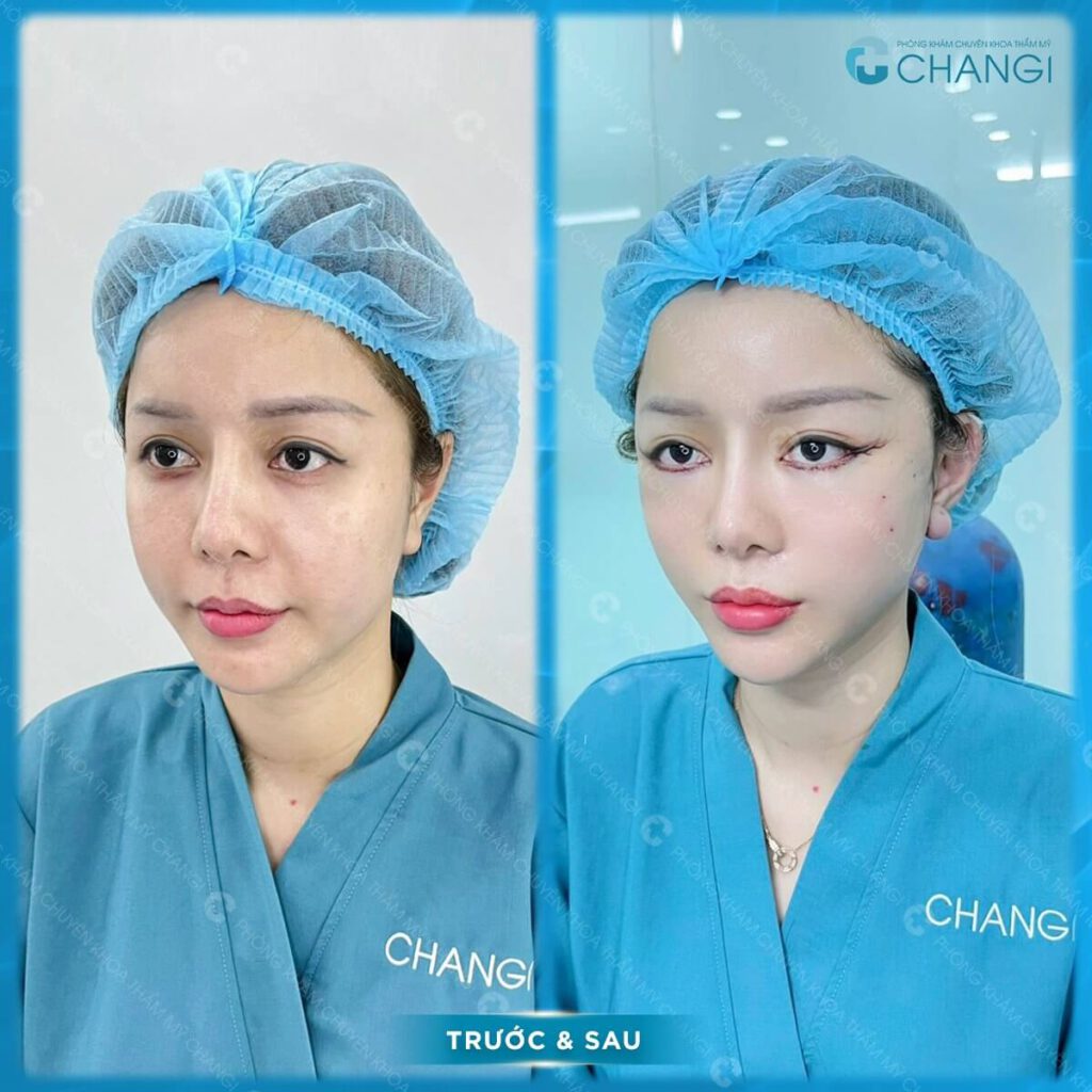 Tác dụng của căng da mini plus