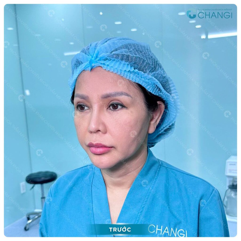 Tình trạng cần căng da mini plus tại changi