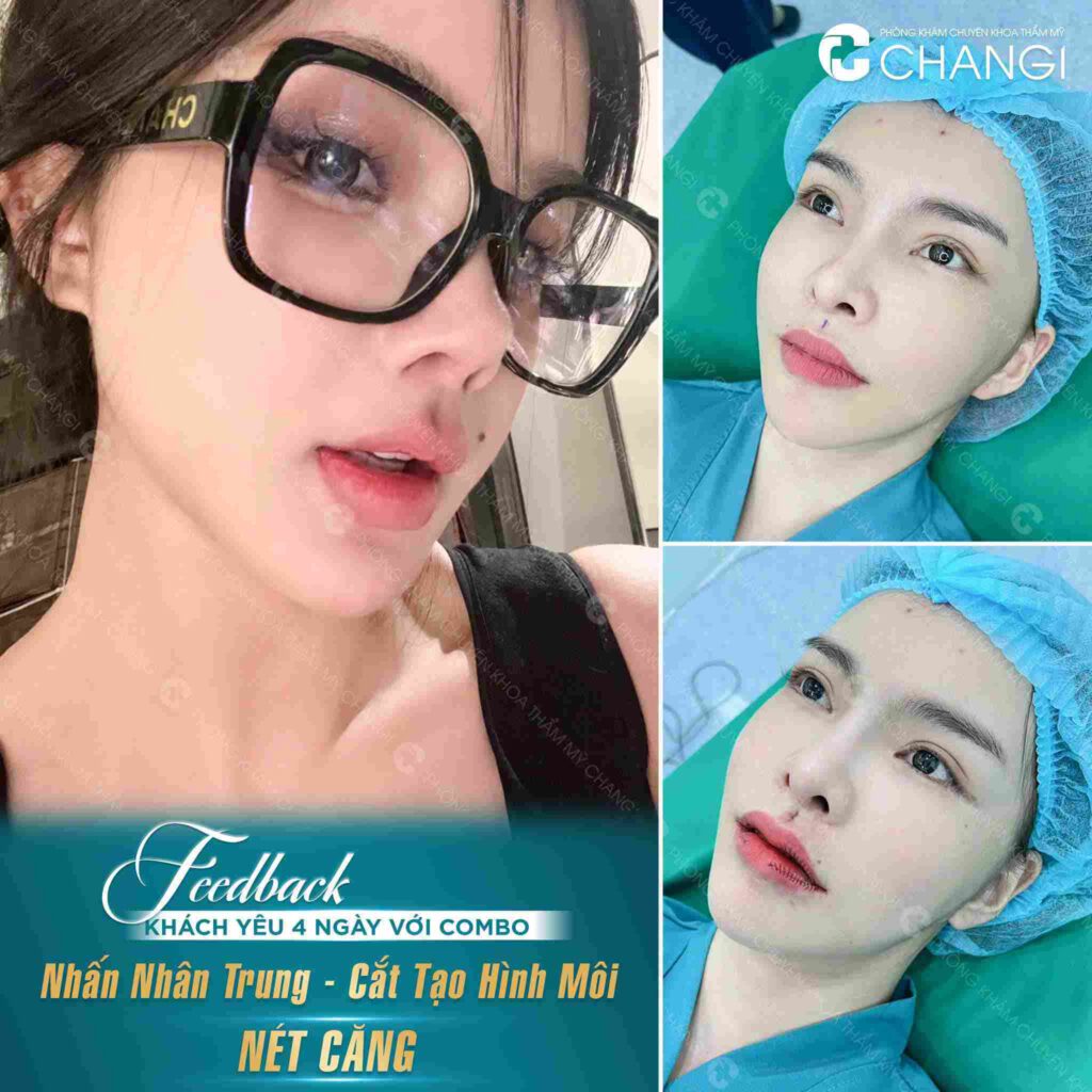 Nhấn nhân trung sau 4 ngày tại phòng khám CHANGI