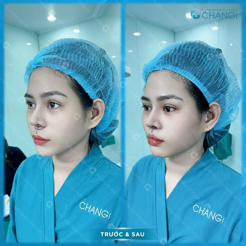 Hiệu quả nhờ thu nhấn nhân trung tại CHANGI