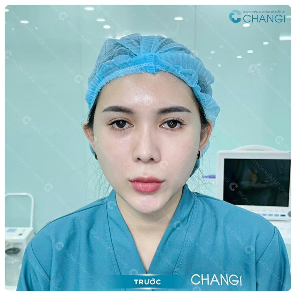 Không có nhân trung khiến khuôn mặt bị dài