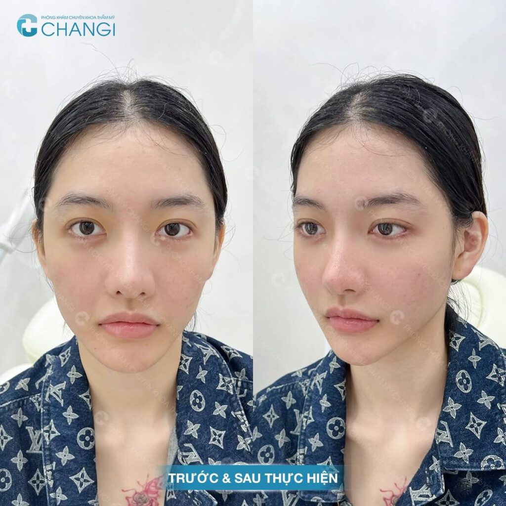 Tiêm MD code nâng cơ mặt tại CHANGI