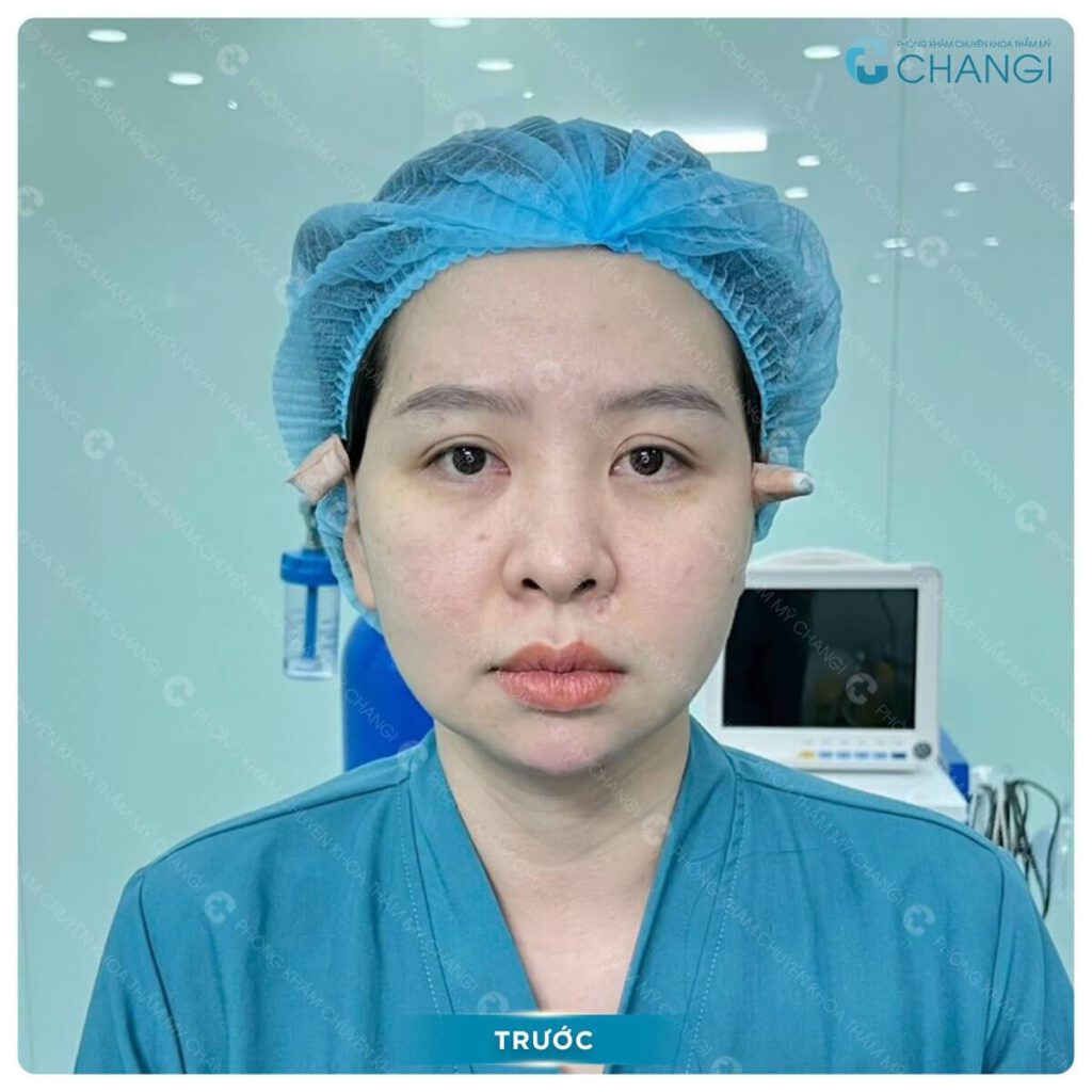 Tình trạng da chảy xệ cần căng da mini plus