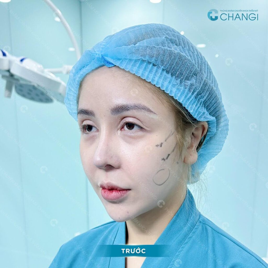 Tình trạng nhân trung bằng phẳng