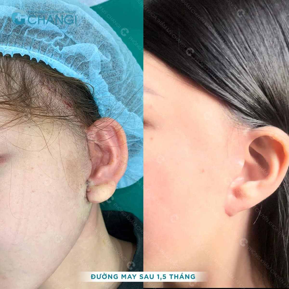 Vết khâu khách hàng làm Căng da Mini Plus