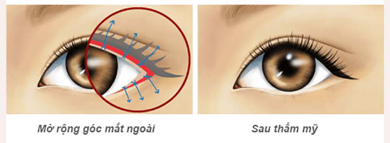 Để tránh biến chứng mở góc mắt ngoài cần kỹ thuật cao, tính toán chính xác
