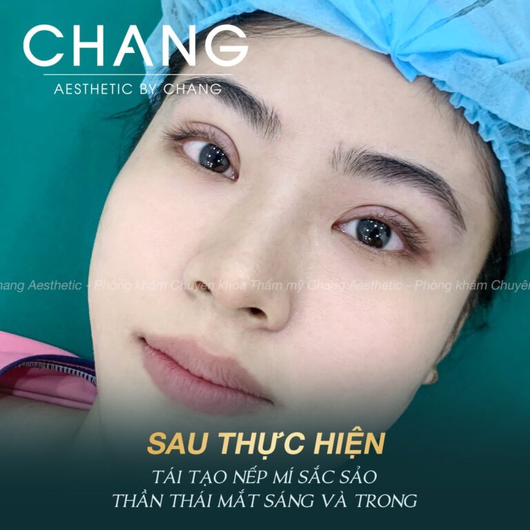 Mắt phục hồi nhanh, cho vẻ đẹp tự nhiên hài hòa