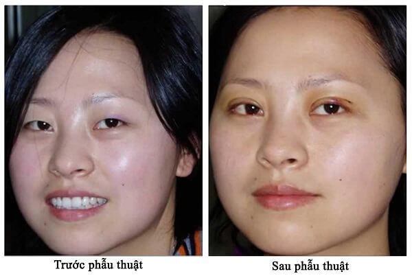 Sẹo ở mí mắt khi thực hiện làm đẹp với cơ sở thẩm mỹ kém chất lượng