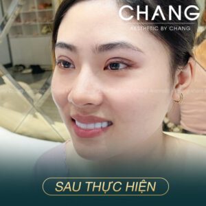Chọn Phòng khám Changi để tuyệt đối an tâm làm đẹp mắt với phương pháp tiên tiến nhất