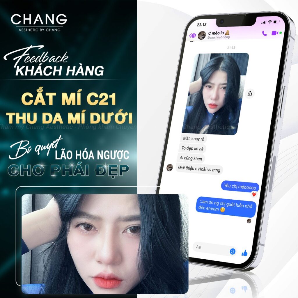 Cắt mí Plasma có tốt không và những điều thú vị có thể bạn chưa biết