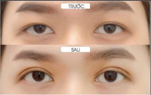 Cắt mí Full Plasma giúp trẻ hóa đôi mắt hiệu quả