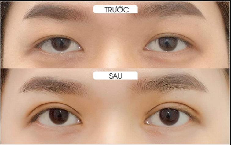 Cắt mí Full Plasma giúp trẻ hóa đôi mắt hiệu quả