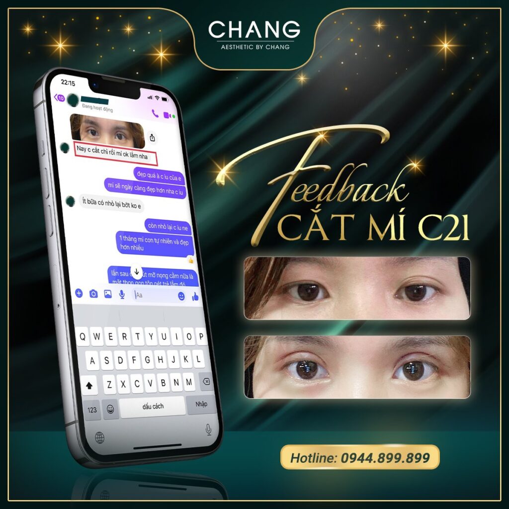 Cắt mí mắt Plasma an toàn, hiệu quả, không gây đau, không để lại sẹo