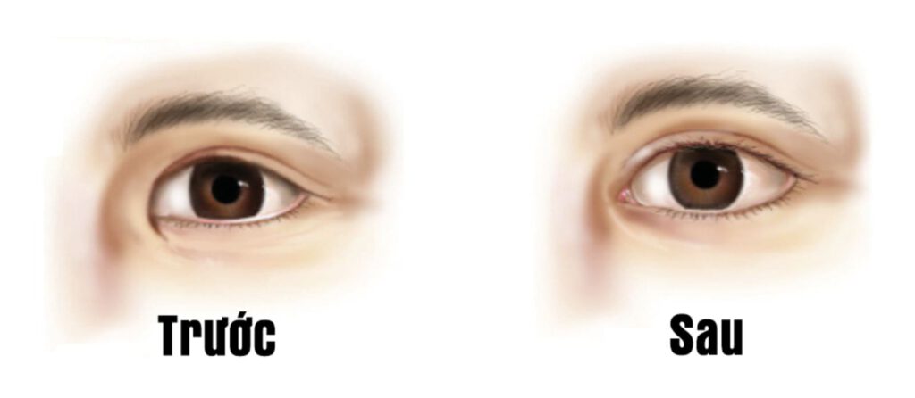 Mở góc mắt trong giúp xóa sạch nếp rẻ quạt, tạo vẻ đẹp tự nhiên hài hòa