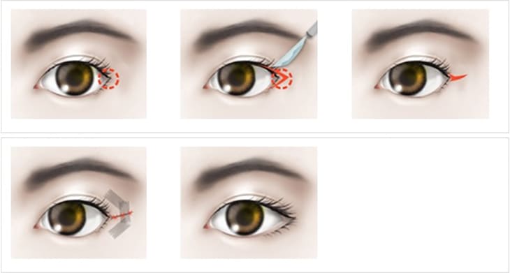 Mở góc mắt ngoài giúp đuôi mắt dài hơn, tạo vẻ đẹp quyến rũ tinh anh