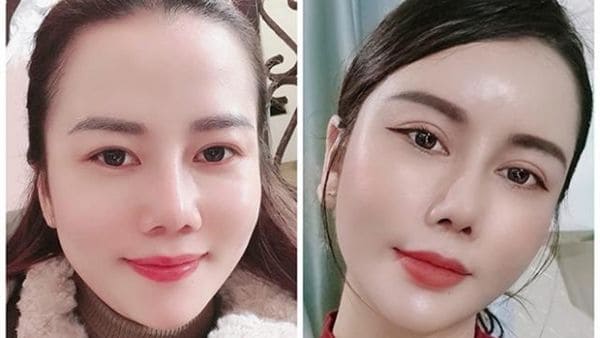 Mở góc mắt an toàn, không sẹo nếu được thực hiện bởi bác sĩ giỏi, tay nghề cao