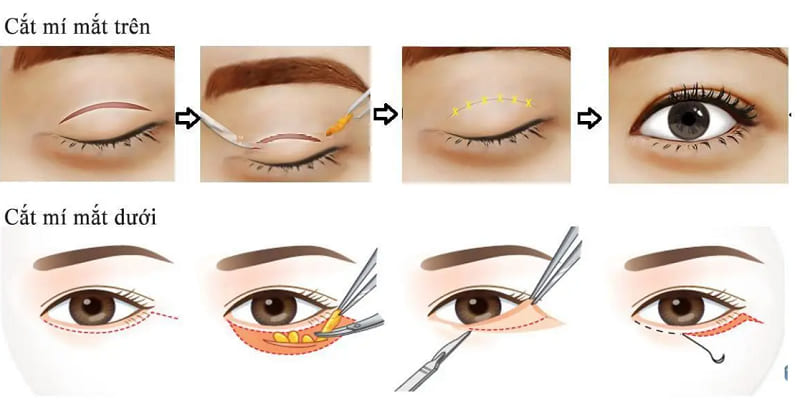 Cắt mí là phương pháp tạo hình mắt 2 mí, khác với cách thực hiện mở góc mắt