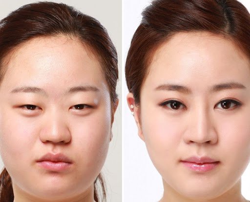 Những người có bọng mắt, mắt sụp mí đều có thể chọn cắt mỡ để cải thiện vẻ ngoài đôi mắt