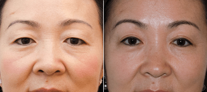 Cắt mỡ mí mắt mang lại đôi mắt to đẹp, tinh anh, trẻ trung