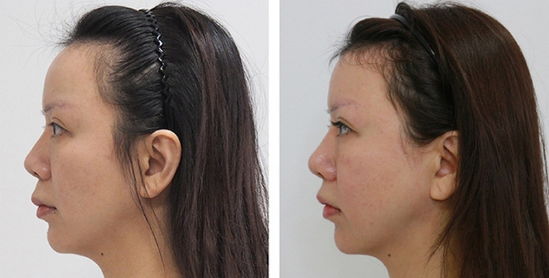 Gọt trán để giảm kích thước trán