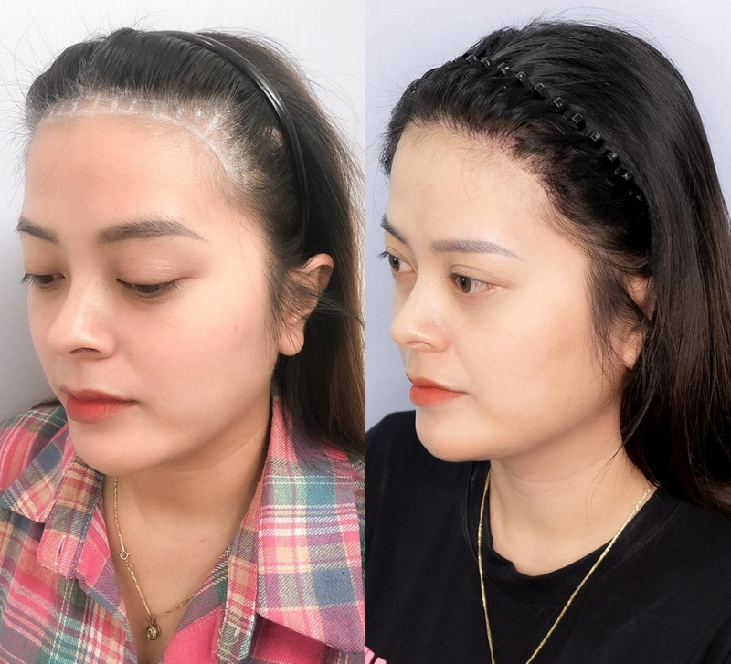 Cấy tóc vĩnh viễn lên trán