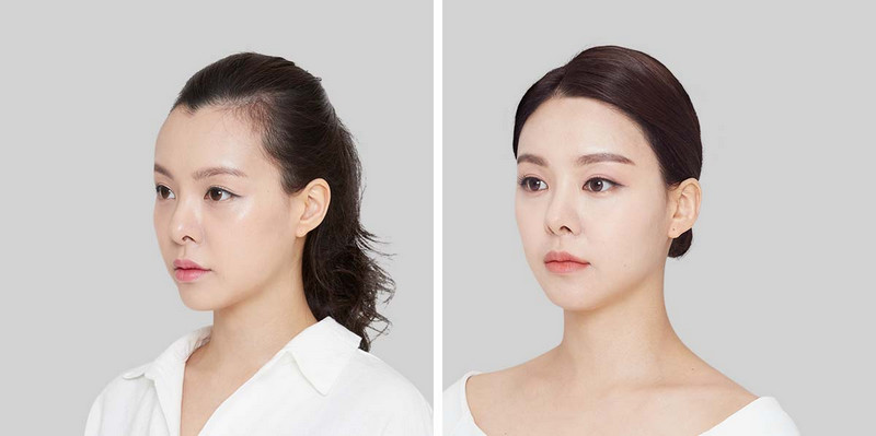 Hạ đường chân tóc thẩm mỹ để che trán cao