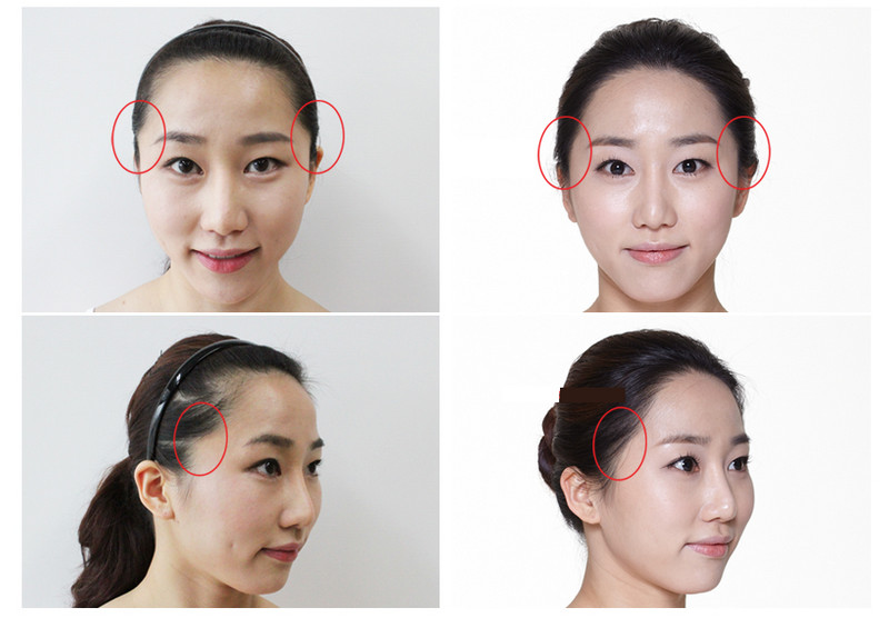 Giải pháp hạ đường chân tóc giúp khuôn mặt thêm hài hòa