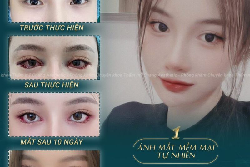 Phẫu thuật mắt xếch có chi phí tùy từng tình trạng và cơ sở thực hiện