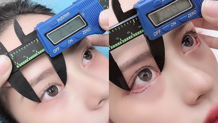 Mở góc mắt hạ xếch là phương pháp phẫu thuật chỉnh hình góc mắt để cải thiện khuyết điểm mắt xếch