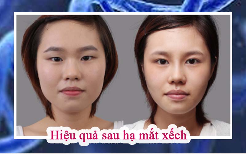 Những người có mắt nhỏ, hẹp, xếch có thể chọn phương pháp này để cải thiện thẩm mỹ mắt