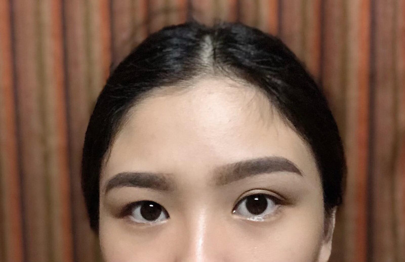 Một bên mắt của bạn nữ bị sụp gây mất sự hài hòa cho đôi mắt
