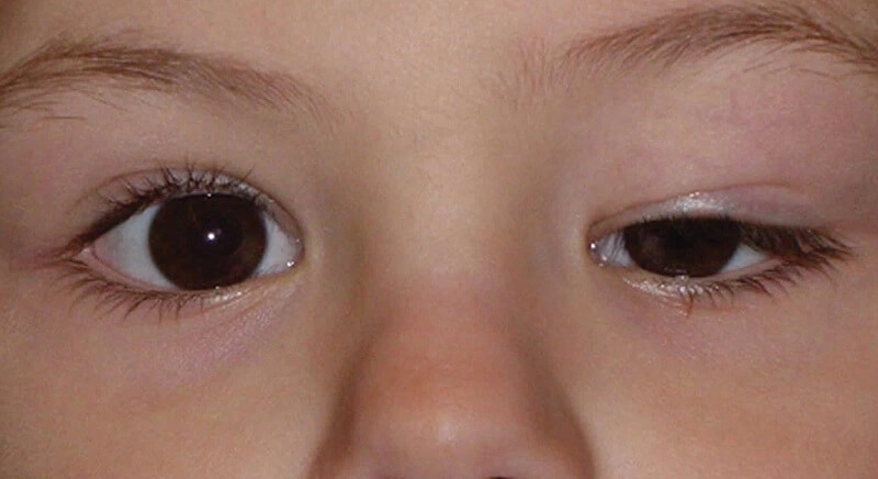 Tình trạng mắt to mắt nhỏ không cân đối ở trẻ em