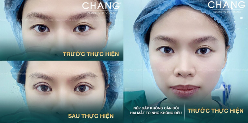 Khắc phục mắt to mắt nhỏ do lệch mí tại Phòng khám Changi