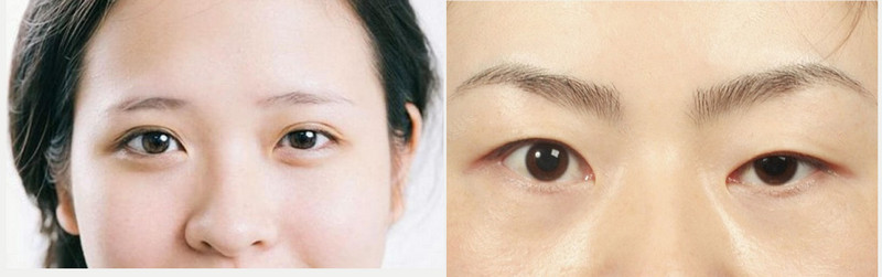 Mắt to mắt nhỏ hiện chưa thể chữa khỏi bằng thuôc