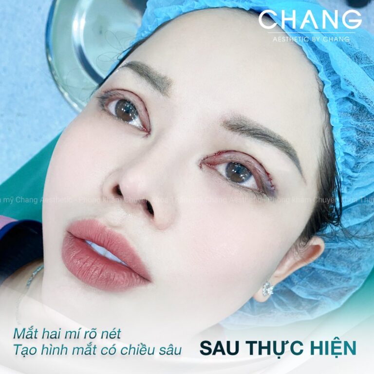 Mắt đẹp tự nhiên, hiệu quả thấy ngay sau khi phẫu thuật