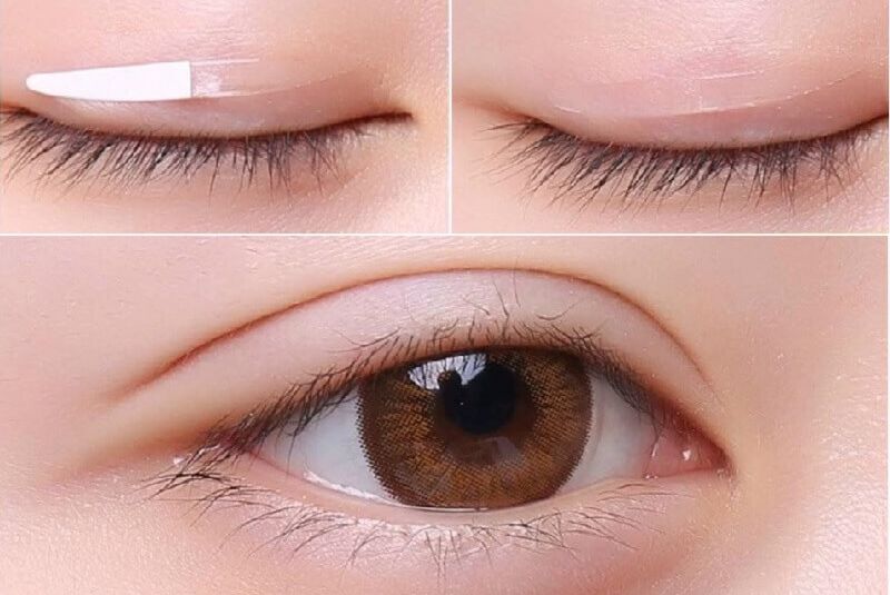 Kích mí, nâng mí có thể tạm thời khắc phục tình trạng mắt xếch