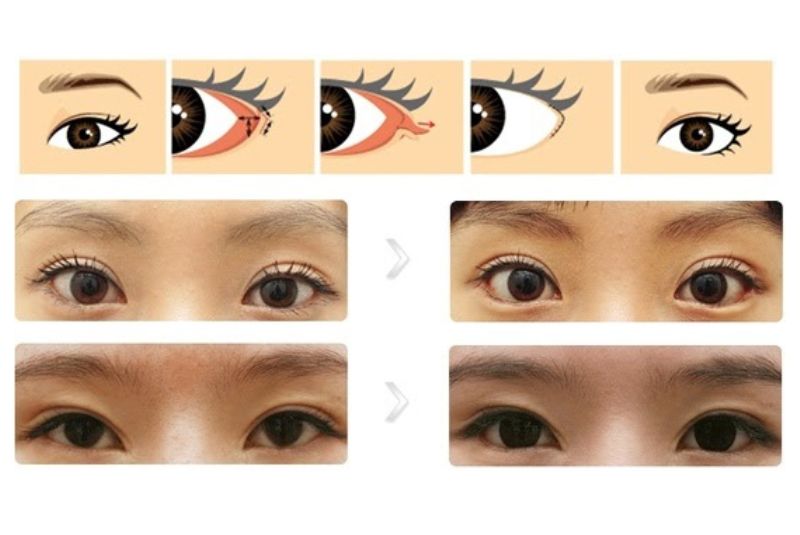 Kết quả phương pháp mở góc mắt hạ xếch