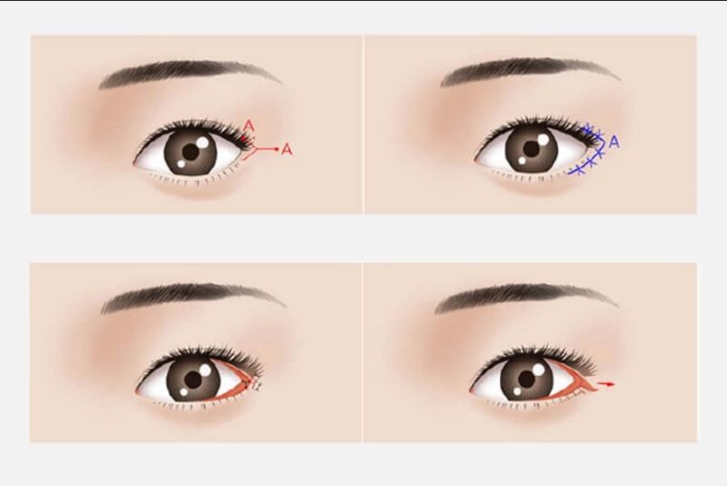 Mở rộng góc mắt có thể sửa mắt xếch hiệu quả